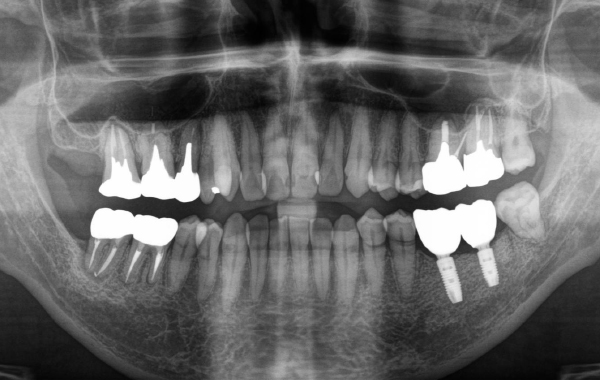 インプラントの症例