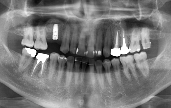 インプラントの症例