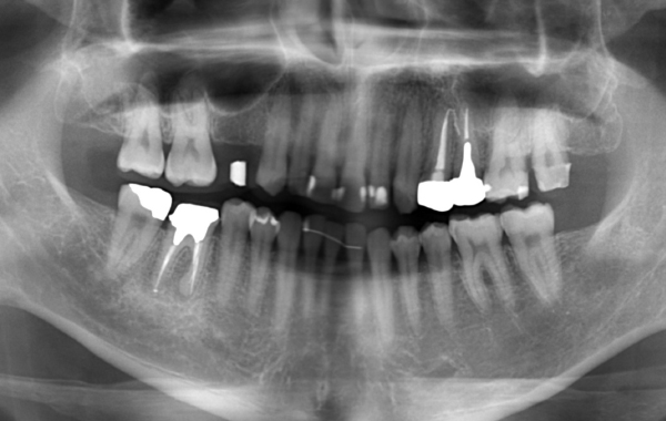 インプラントの症例