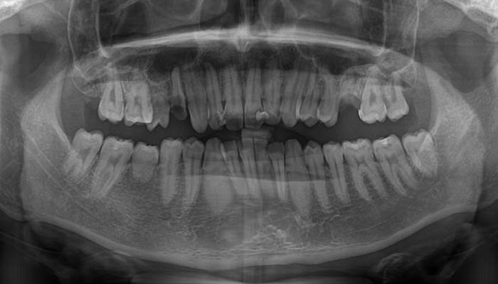 歯の保存治療の症例