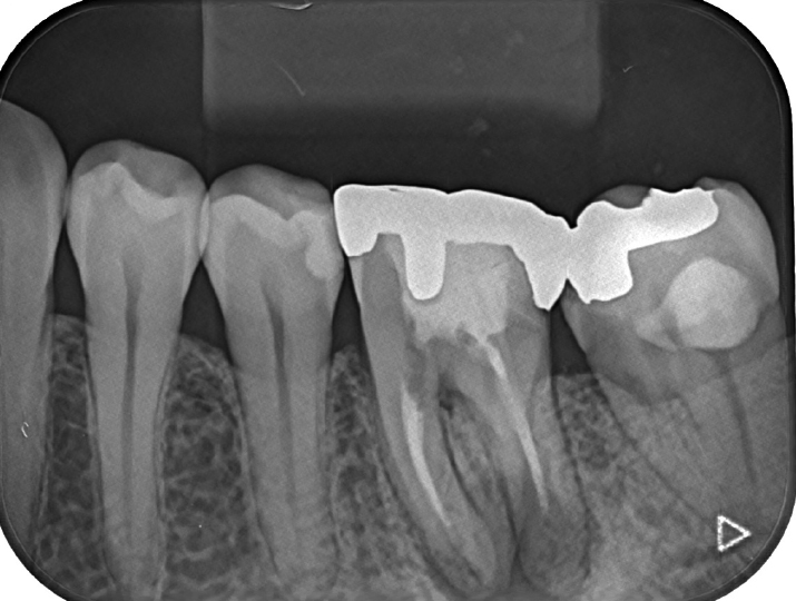 歯の保存治療の症例