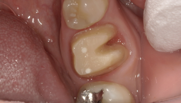 歯の保存治療の症例