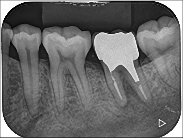 歯の保存治療の症例