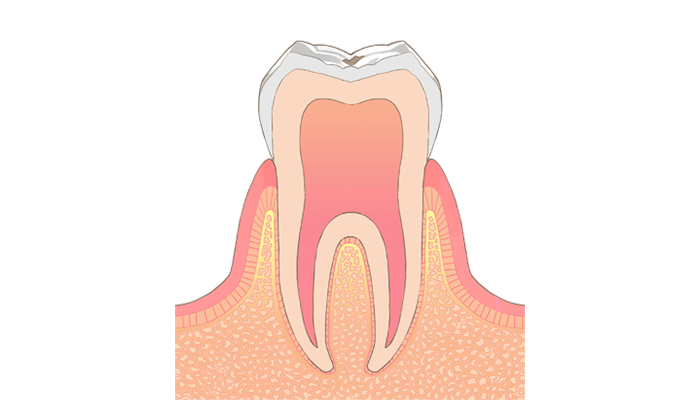 C0:初期症状がみられる要観察歯