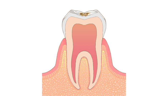 C1:エナメル質の虫歯