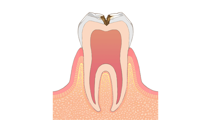 C2:象牙質の虫歯
