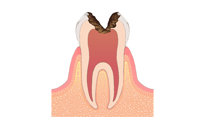 C3:歯の神経の虫歯