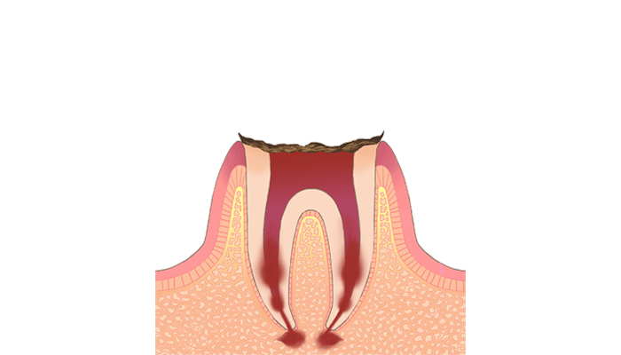 C4:歯の根の虫歯