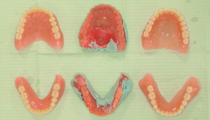 当院での安定する快適な義歯を作る工夫