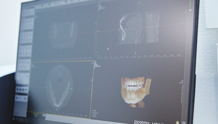 術前のCT撮影による精密な診査、骨の状態の把握