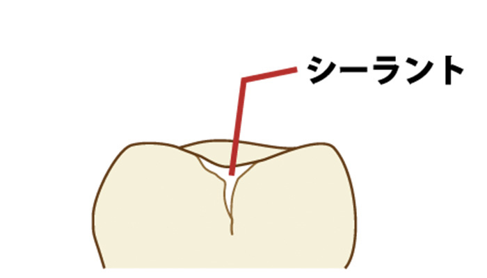 シーラント