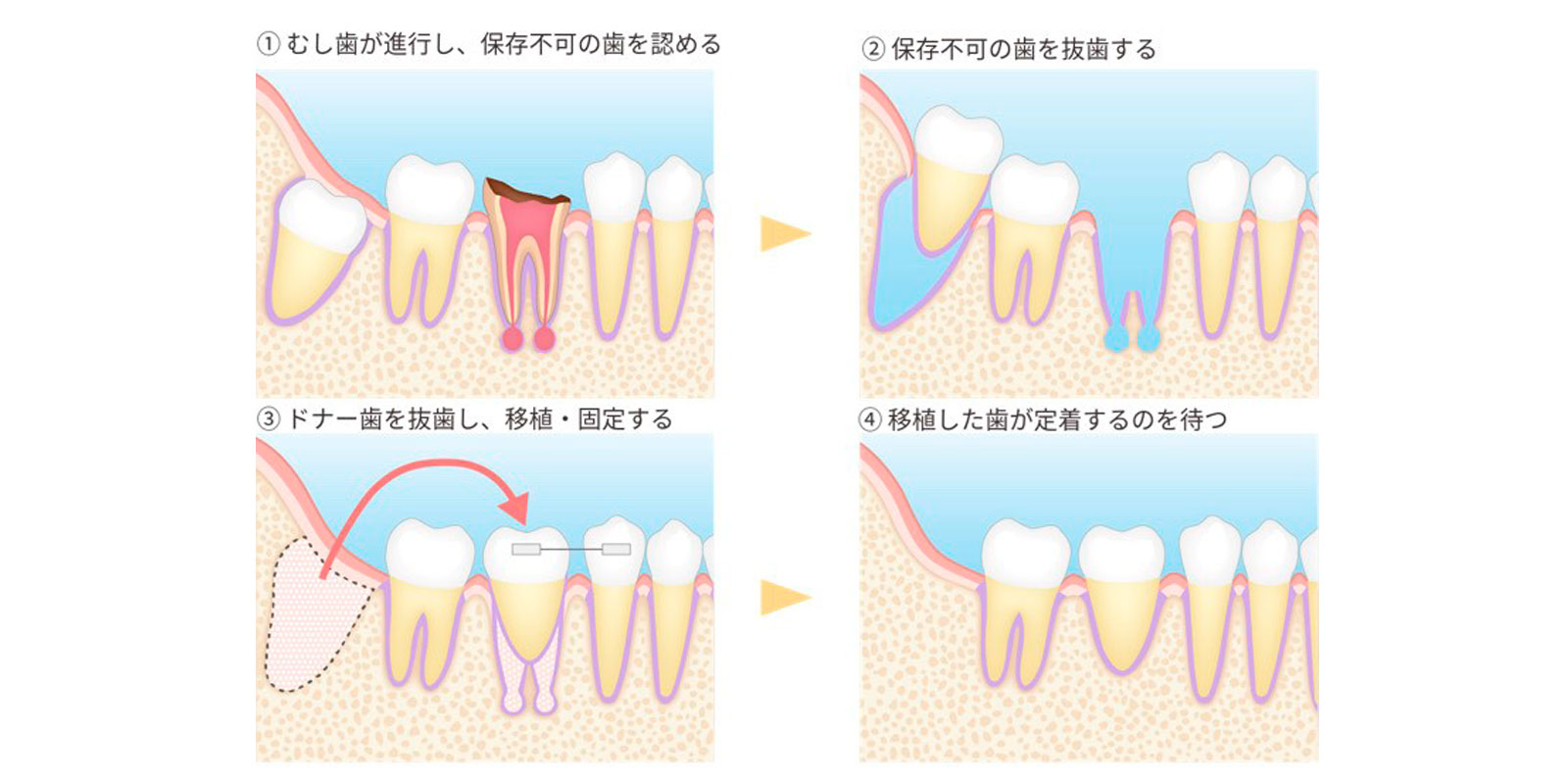 自家歯牙移植