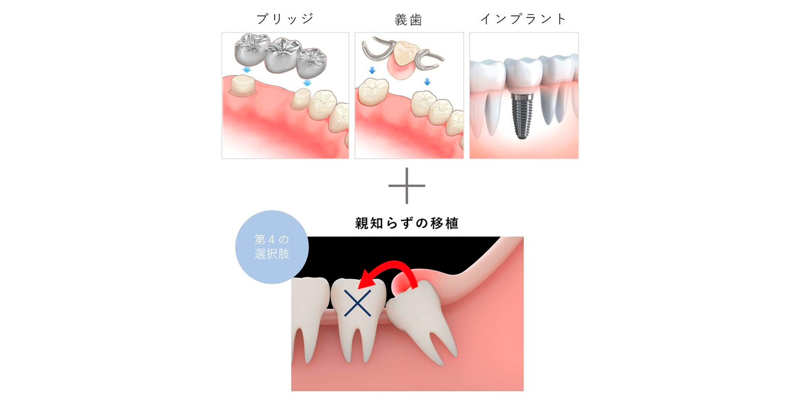 自家歯牙移植