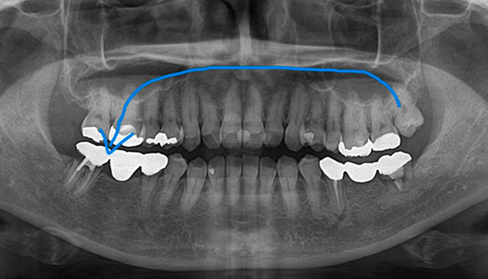 自家歯牙移植の種類