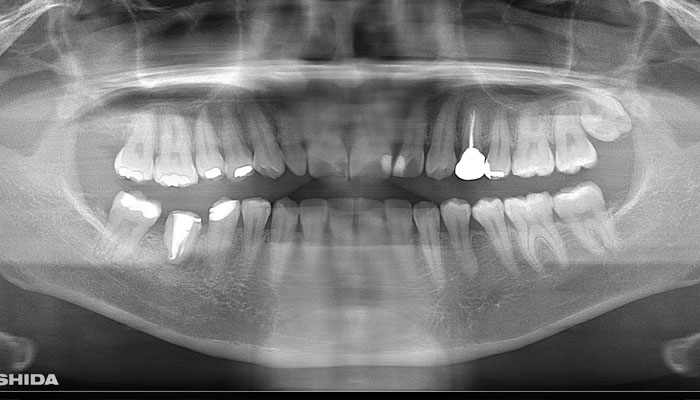 自家歯牙移植の種類